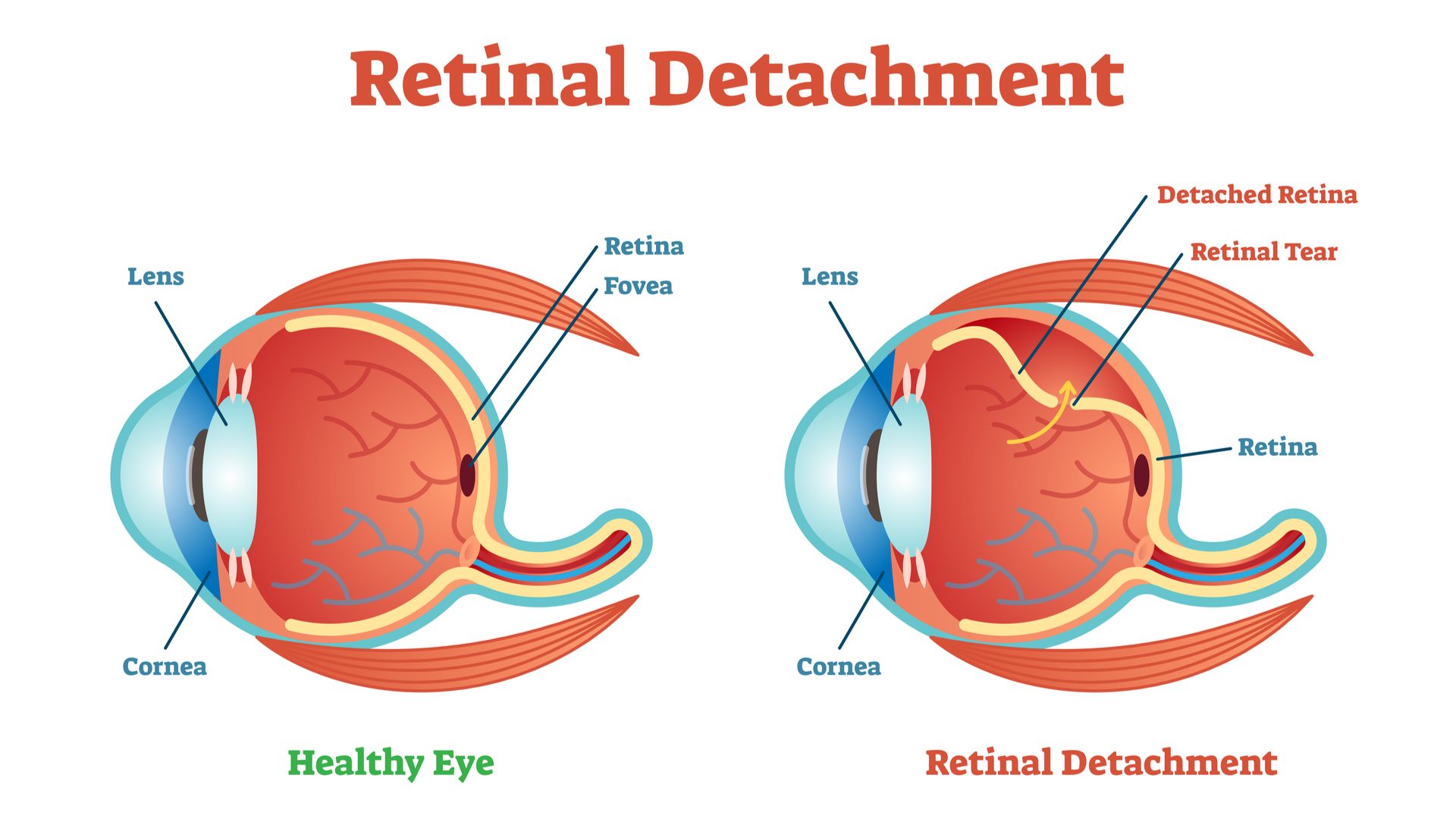 Retinal Detchment Diagram